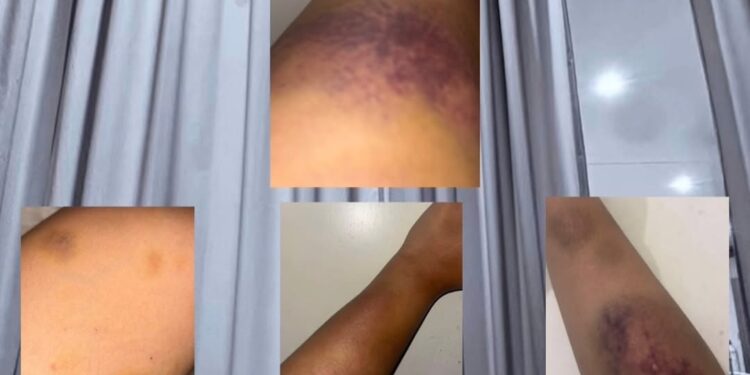 Diduga Dianiaya Oleh Kekasih Oknum Brimob Korban Berharap Pelaku Ditangkap