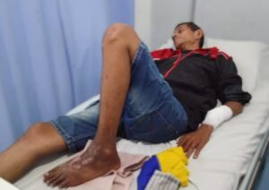 Tangan Patah Diduga Dipukul Abang Kandung Malah Mengaku Jadi Korban