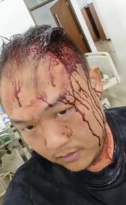 Viral Tegur Pesta Miras Tengah Malam, Warga Siantar Utara Luka Robek di Kepala Dianiaya Oknum Ormas
